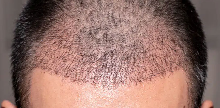 Haartransplantation